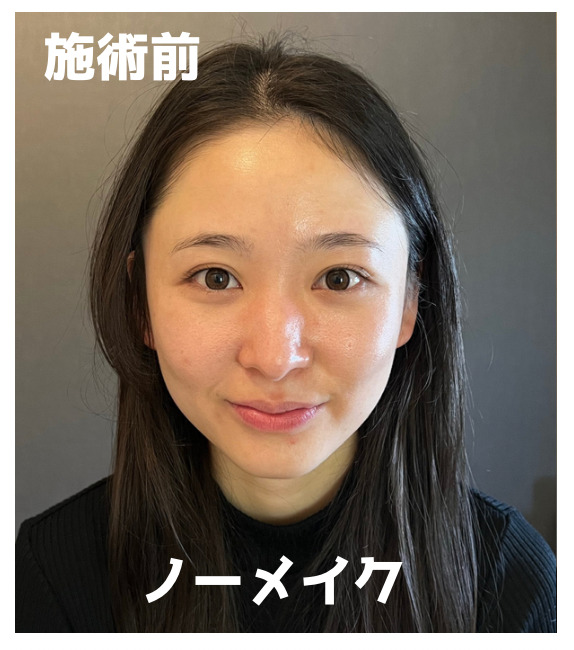 ビフォー